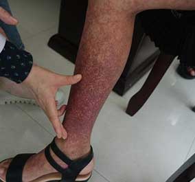 患者腿上的皮损很严重