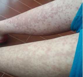 患者的皮疹症状