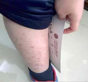患者的紫癜症状
