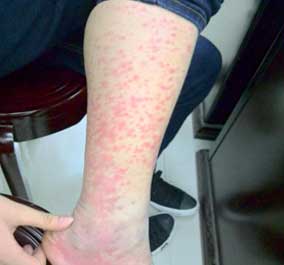 患者现在的紫癜症状
