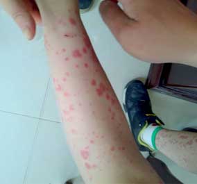患者腿上的皮疹