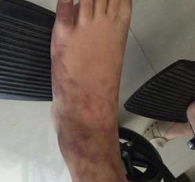 患者的皮疹症状