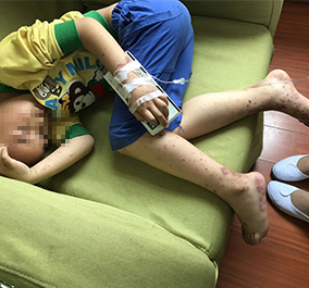收治转诊的腹型紫癜孩子